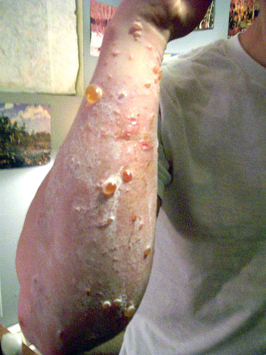 urushiol blistering